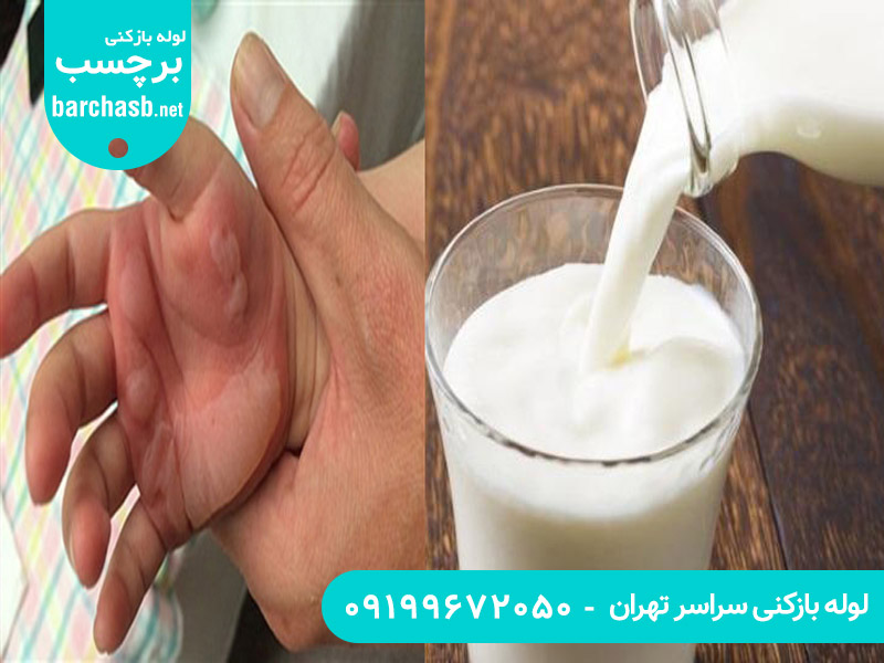 درمان سوختگی با اسید لوله بازکنی به وسیله شیر 